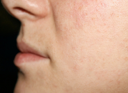 skin imperfections healed